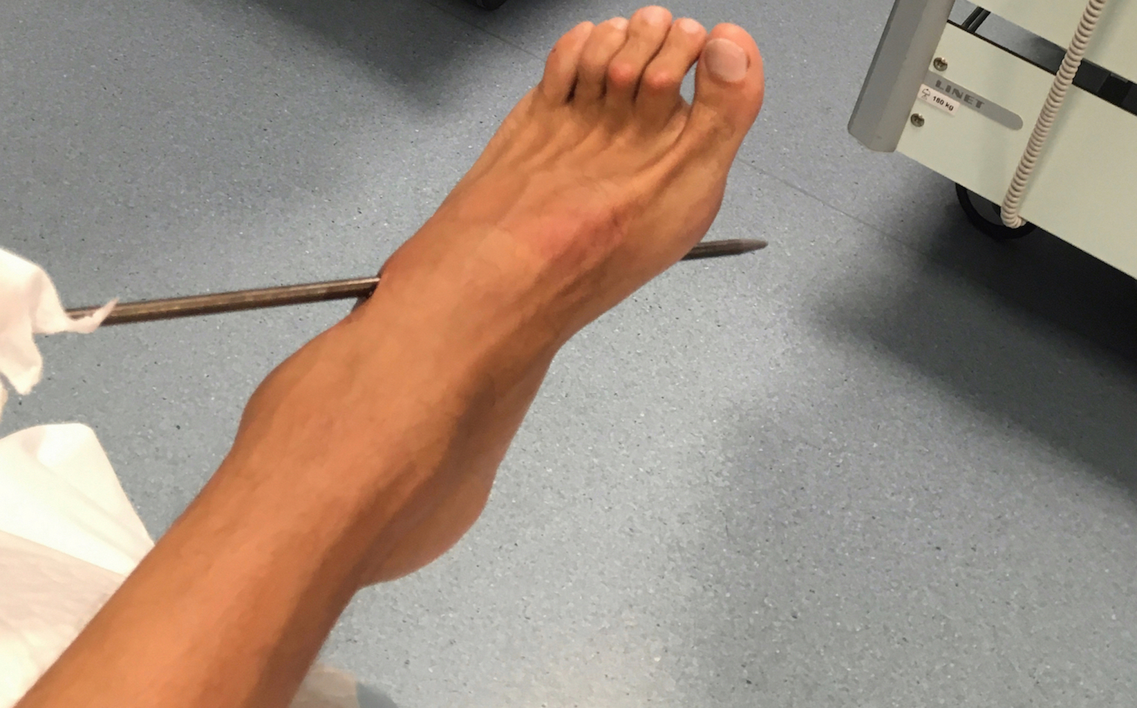 Spearfishing accident